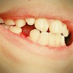 子供の歯の矯正って何歳から?
