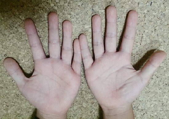 手足口病の写真（手のひら）