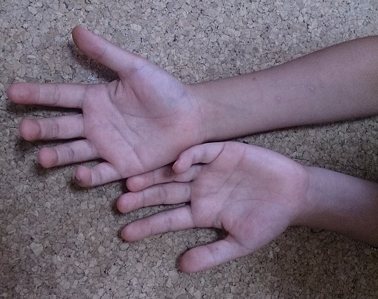 手足口病の写真（手のひら・腕）