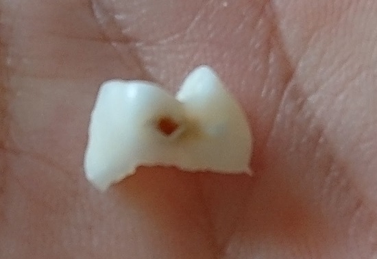 虫歯（乳歯）子どもの歯