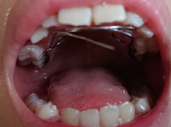 子供の歯の矯正